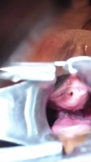 Speculum Cervix & Anal Exam Great View Inside